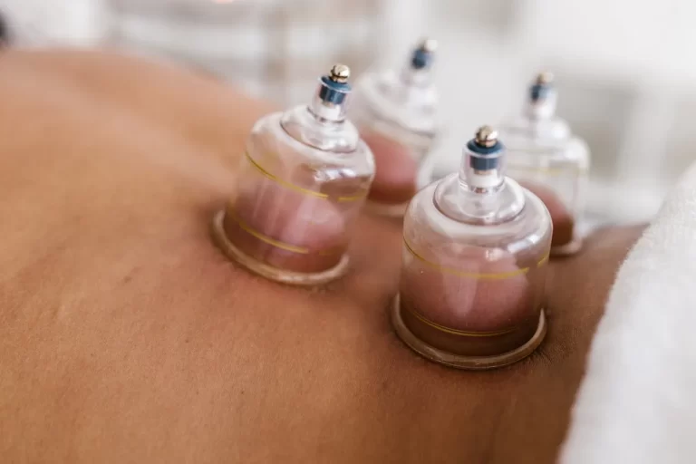 Cupping therapy near me